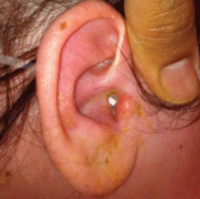 Otitis Externa - Ear, Nose, Throat - Medbullets Step 2/3